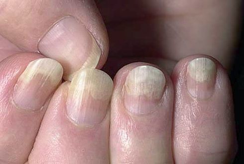 Отслаивание ногтевой пластины от мягких тканей