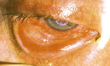 Синдром Стивенса-Джонсона. Двусторонний десквамативный конъюнктивит с участками некроза. Тяжелый кератит, ставший причиной появления рубцов на роговице. Ситуация осложнилась присоединением синдрома «сухих» глаз