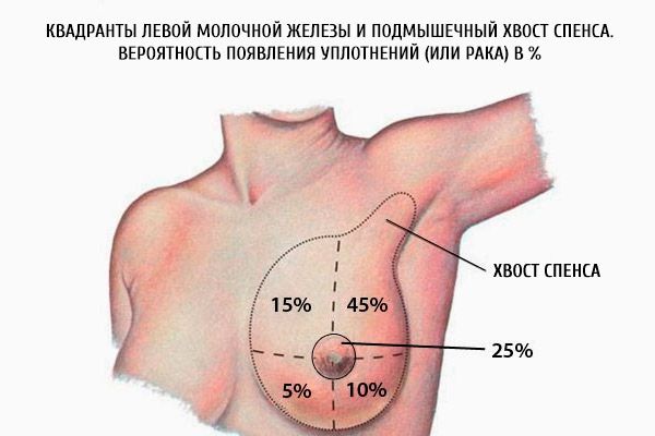 Квадранты левой молочной железы и подмышечный хвост спенса. Вероятность появления уплотнений (или рака) в %