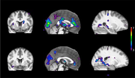 Сканирование показывает области активности мозга в ответ на раздражители у людей с быстрым метаболизмом никотина (верхний ряд) и медленным метаболизмом никотина (нижний ряд)