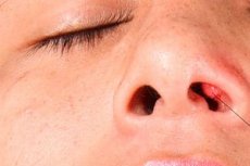 Фурункул носа : причины, симптомы, диагностика, лечение ...