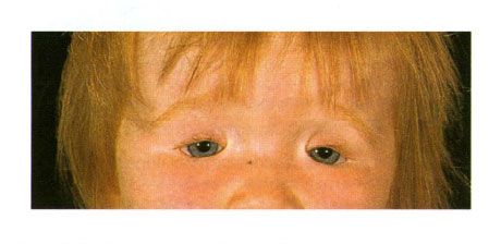 Двусторонняя колобома век у ребенка с синдромом Гольденара. Несмыкание глазной щели слева