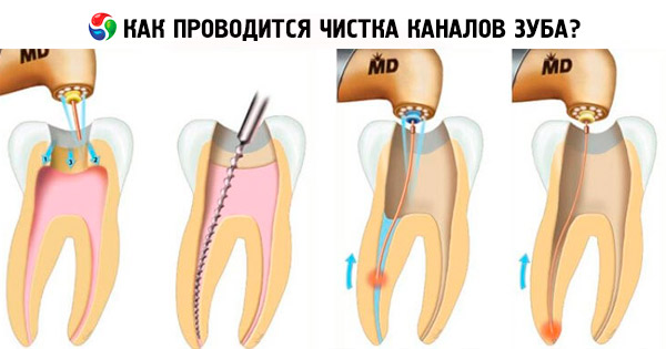 Лечение каналов зуба последствия