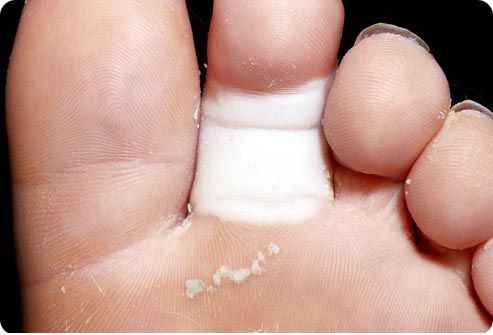 Причины переломов пальцев стопы