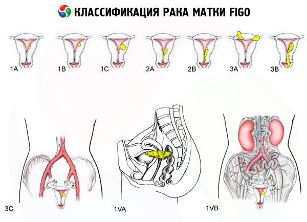 Рак тела матки код по мкб 10 у взрослых