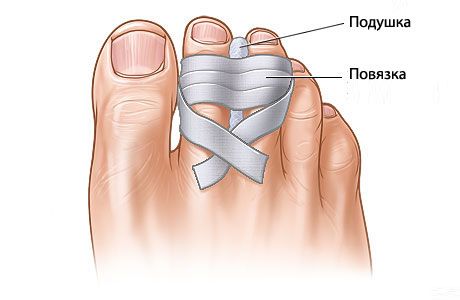 Каковы перспективы восстановления сломанных пальцев ног?