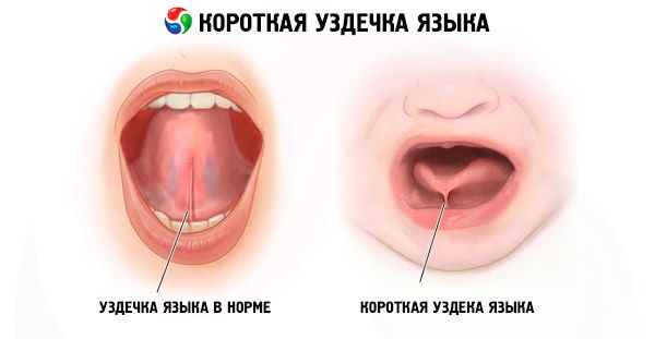Белый налет на языке и трещины причины — Зубы