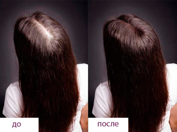 Уколы против выпадения волос у женщин