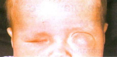 Микрофтальм с сопутствующим кистообразованием (левый глаз). Анофтальм (правый глаз). 