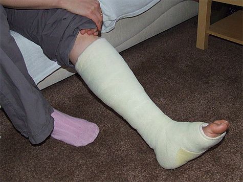 Меры в домашних условиях при переломе ног