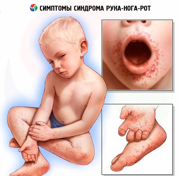 Синдром рука нога рот энтеровирусный везикулярный стоматит