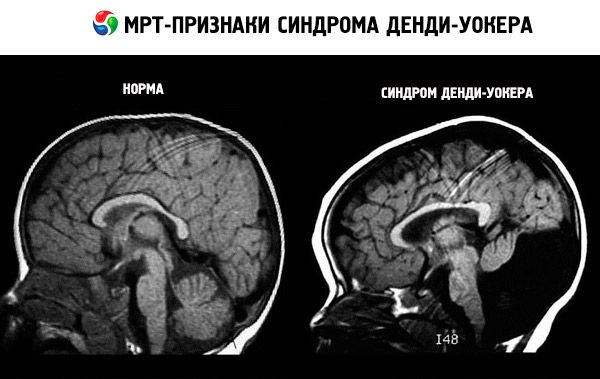 Аномалия развития головного мозга синдром денди уокера thumbnail