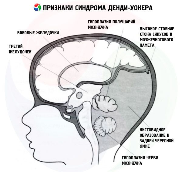 Аномалия развития головного мозга синдром денди уокера