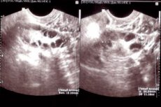 placentarnyy polip endometriya