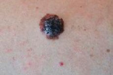 uzlovaya melanoma