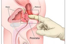 massazh prostaty