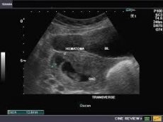 hematoma pregnancy