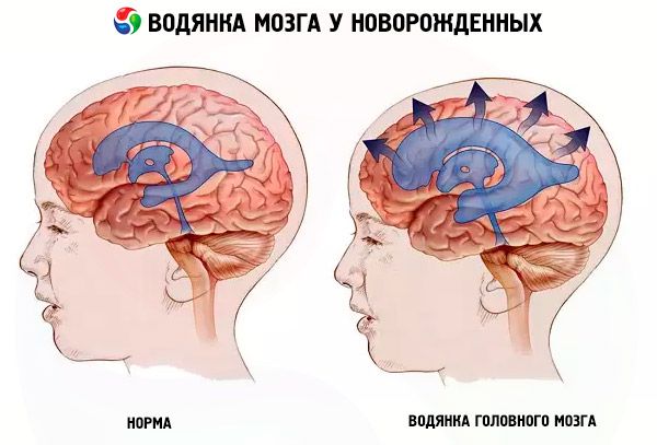 Водянка головного мозга у новорожденного